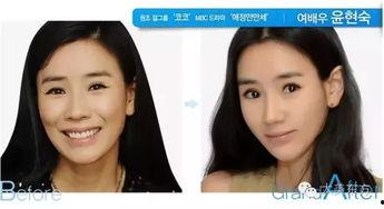 面部吸脂明星,揭秘面部吸脂术的神奇魅力